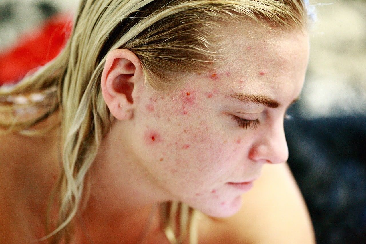 Having acne can cause depression. anxiety, and low self-esteem.