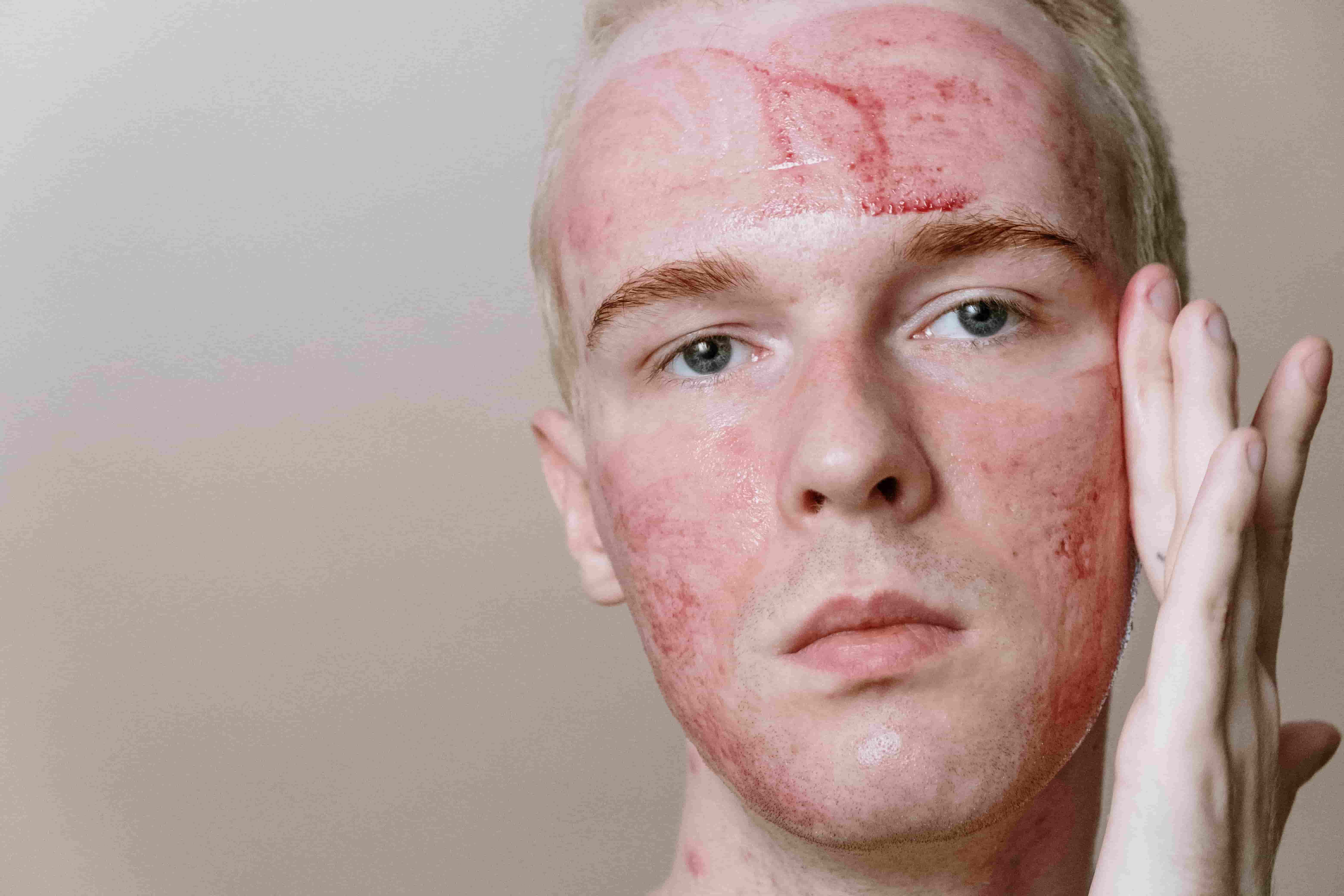 Acne Rosacea is a type that usually occurs with fair-skinned people.