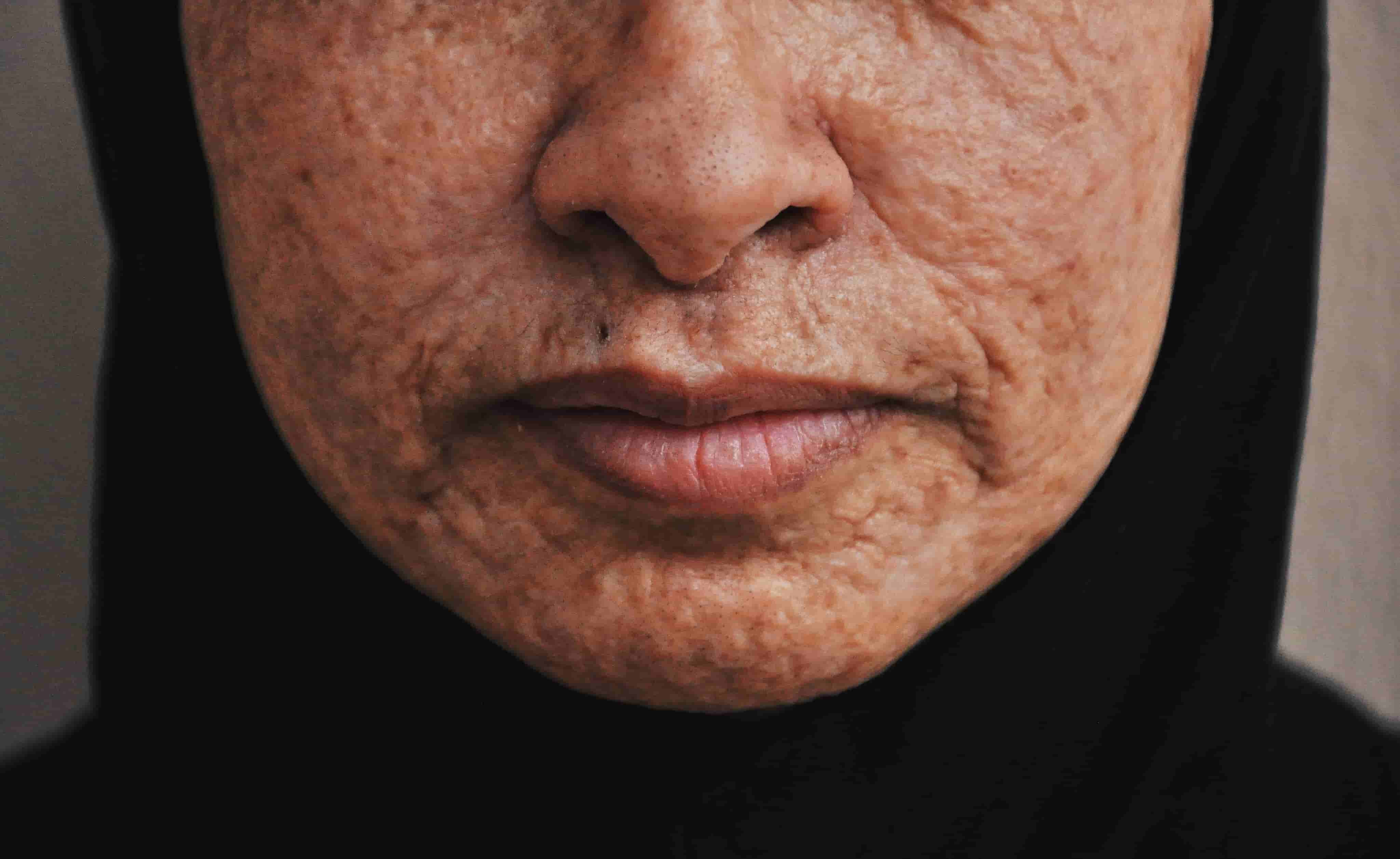 Acne left untreated can possibly end up as permanent scars.