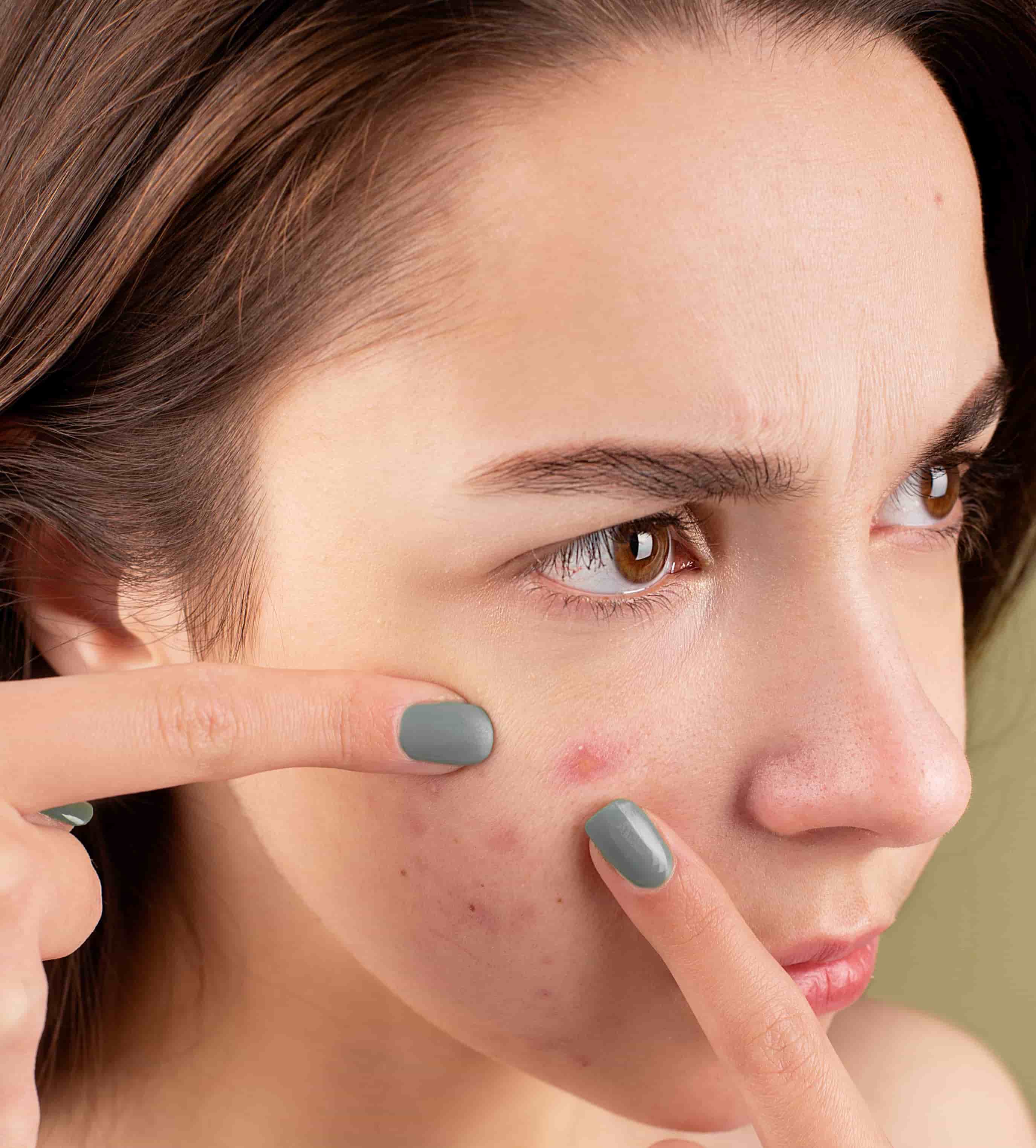 Best Essential Oils For Acne Can Be The Best Acne Treatments